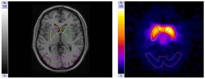 Responsivity of the Striatal Dopamine System to Methylphenidate—A Within-Subject I-123-β-CIT-SPECT Study in Male Children and Adolescents With Attention-Deficit/Hyperactivity Disorder